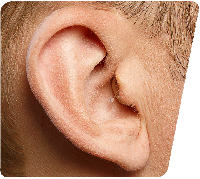 Seitenansicht eines menschlichen Ohrs mit einem In-dem-Ohr-Hörgerät, das sich unauffällig in die natürliche Form des Ohrs einfügt.
